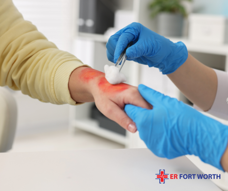 10 Common Burn Treatment Mistakes to Avoid