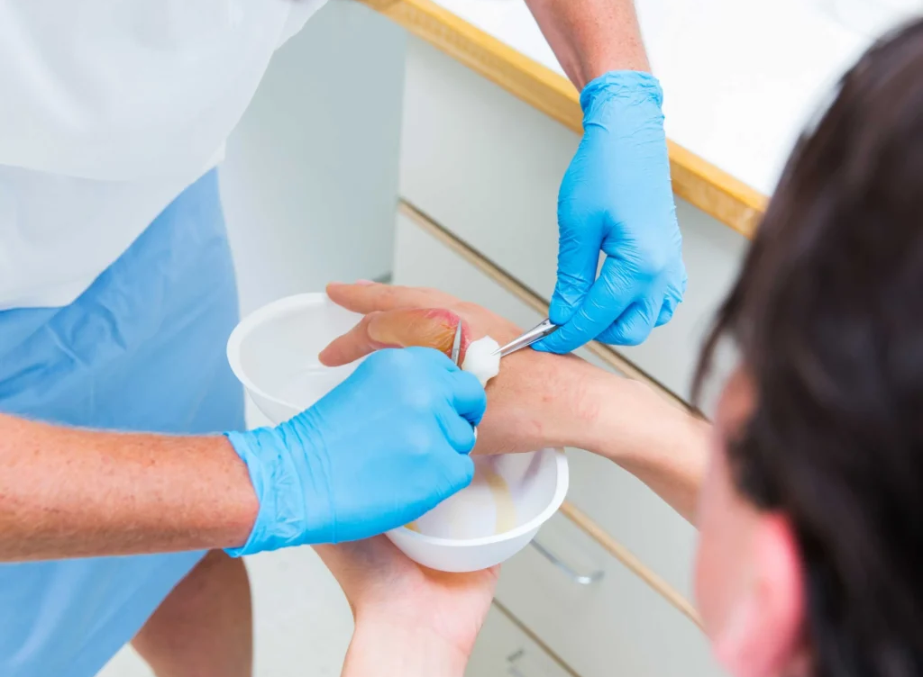 7 Essential Burn Treatment Steps for Faster Healing | ER OF FORT WORTH 