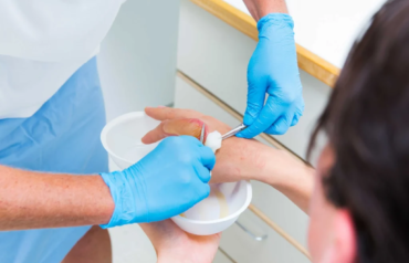 burn treatment