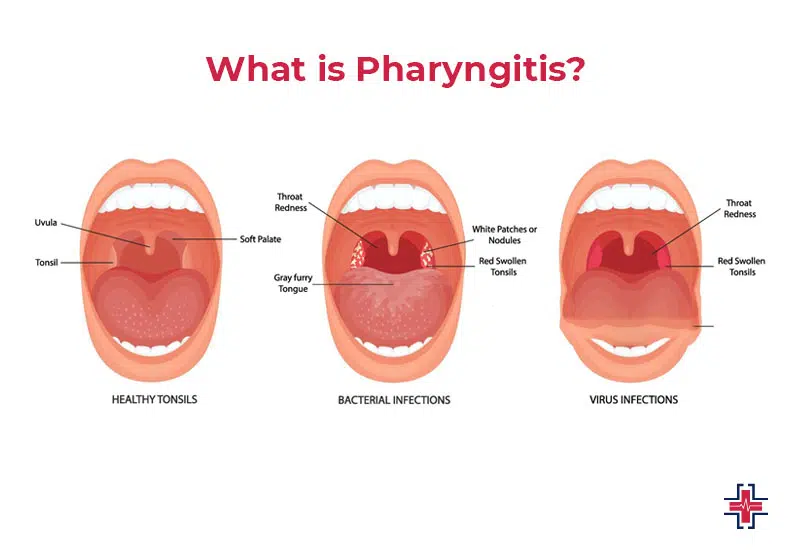 acute pharyngitis